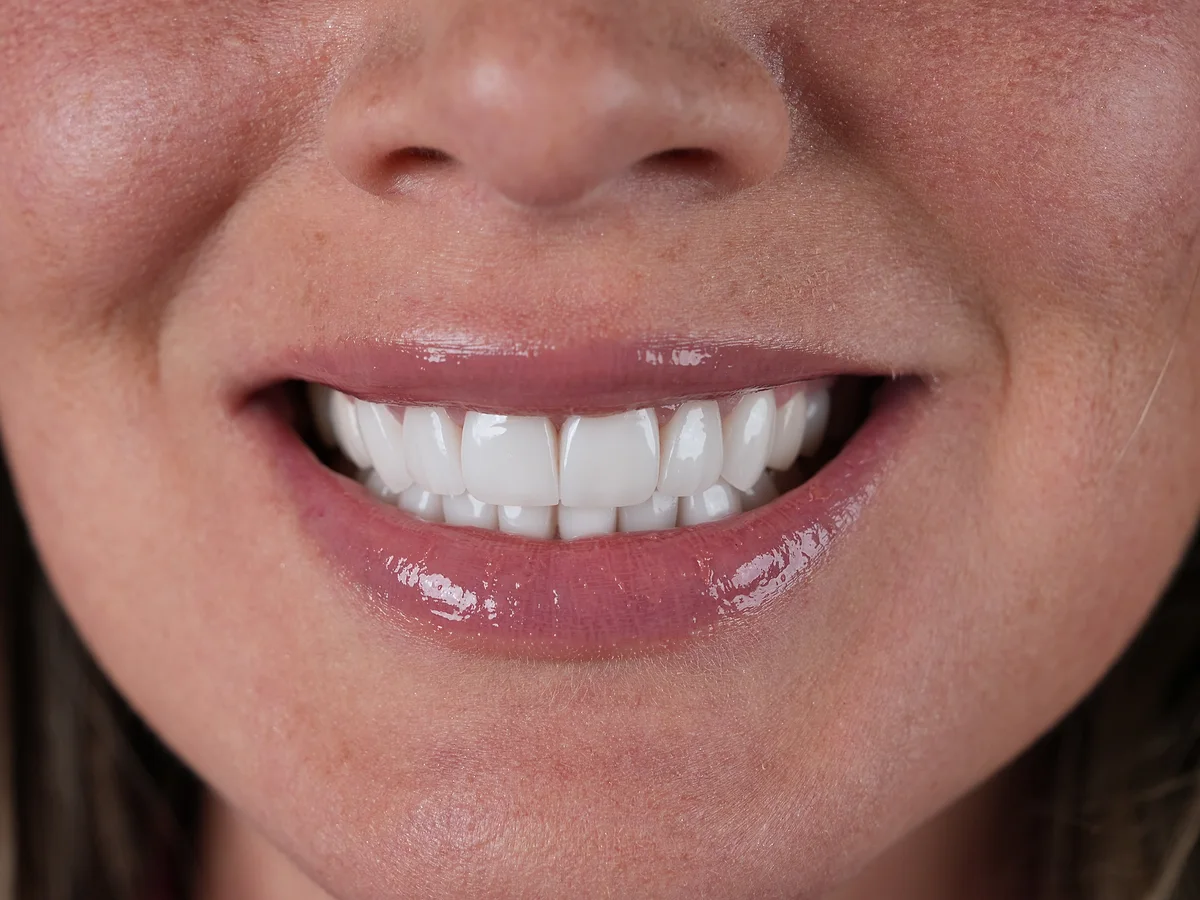 After — Same-Day Composite Smile Makeover