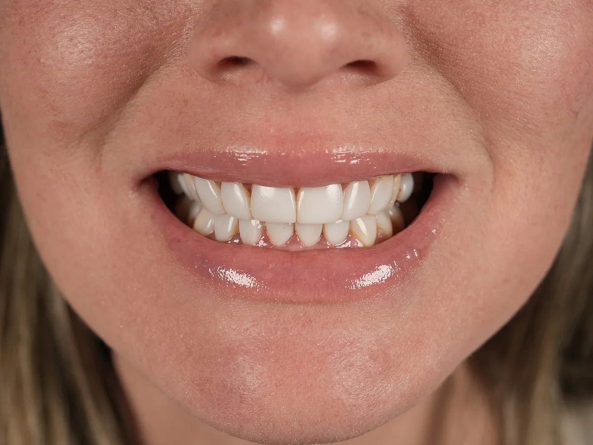 Before — Same-Day Composite Smile Makeover