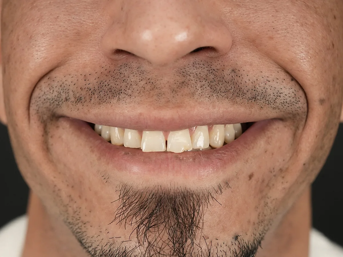 Before — Composite Veneers — Smile Dental Center